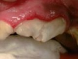 Fractured tooth--crown prep