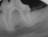 Xray of bioglass implant