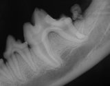 Xray showing buried molar
