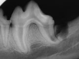 Xray of extracted molars