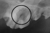 X-ray of abscessed tooth